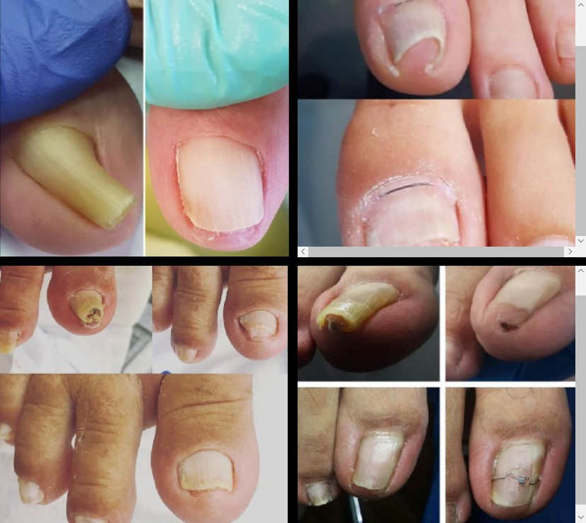 Toenail Physics and Treatment for Ingrown Toenails - Sports and