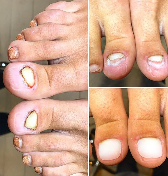 Seven Myths about Ingrowing Toenails - Sports and Structural